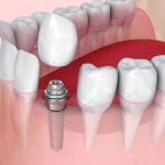 Kelebihan Implan Gigi, dan Prosedur Pemasangannya