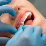 Habis Pasang Kawat Gigi? Jangan Lupa Lakukan 6 Perawatan Ini!